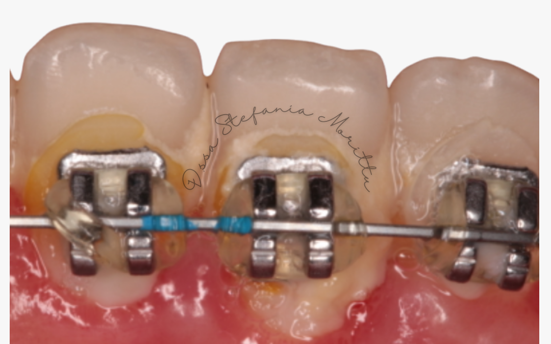 L’importanza dell’igiene orale durante il trattamento ortodontico